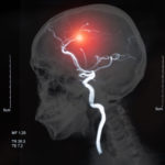 Brain Angiography