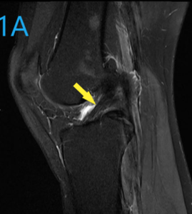MRI of intact ACL