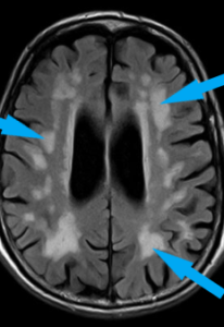 brain MRI scan image