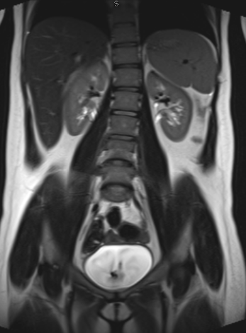 Abdomen MRI