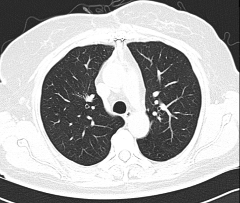 low dose lung screening
