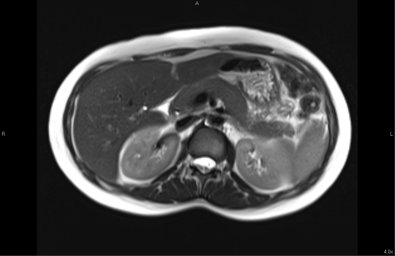 abdomen MRI