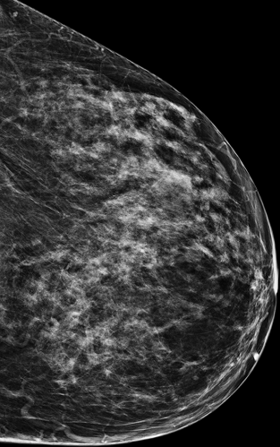 Screening Mammogram